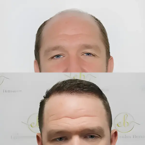 FUE hairline & mid-scalp — 3,796 grafts / 8,241 hairs