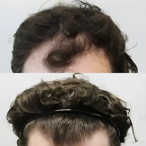 FUE receding hairline — 2,003 grafts / 3,939 hairs