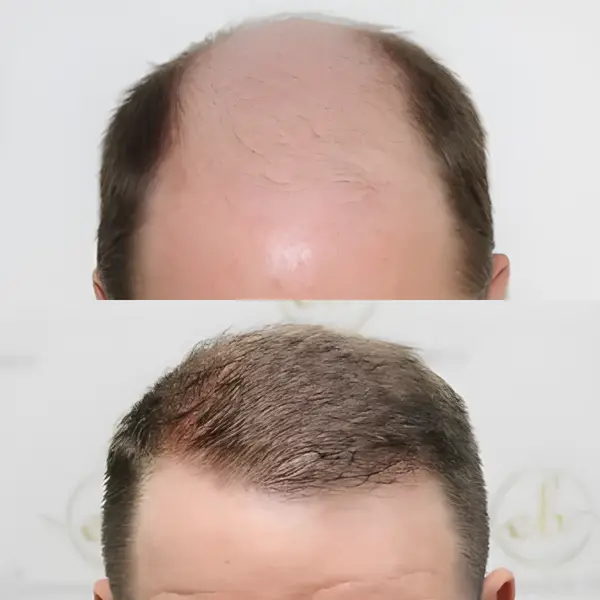 FUE hairline & mid-scalp — 3,796 grafts / 8,241 hairs