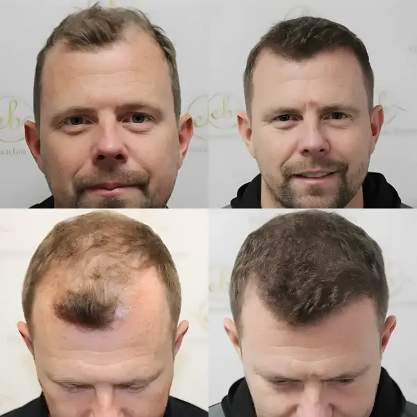 FUE hairline & mid-scalp — 4,049 grafts / 12,260 hairs