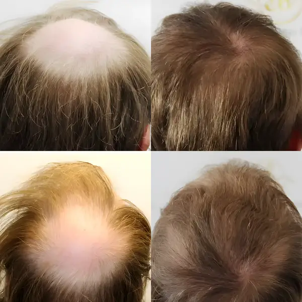 FUE crown transplant — 2,000 grafts