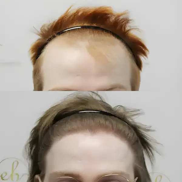 FUE frontal & crown restoration — Dr Bonaros