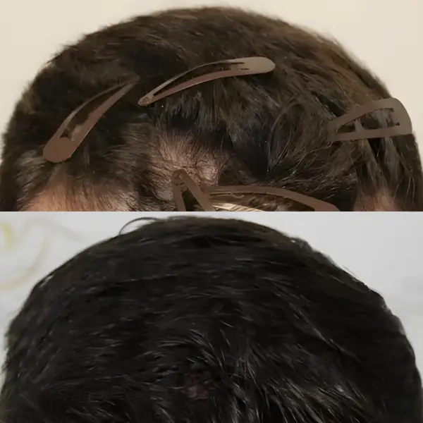 FUE receding hairline — 1,456 grafts / 3,621 hairs
