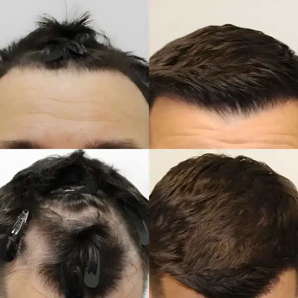 FUE hairline transplant — 1,500 grafts (temples)
