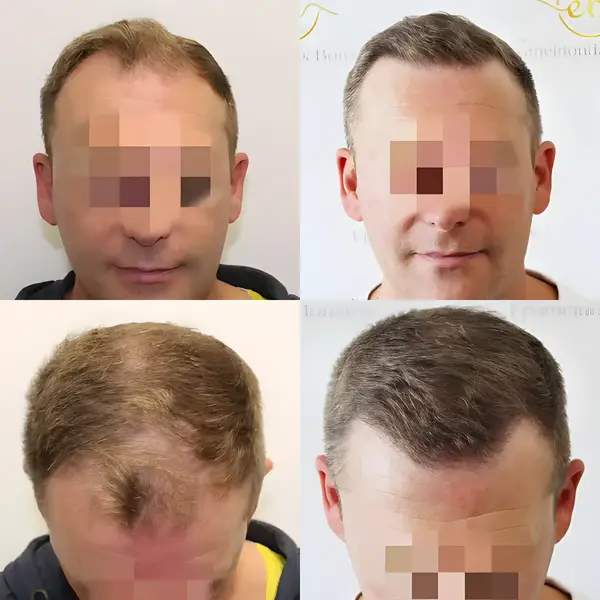 FUE hairline transplant — 1,841 grafts