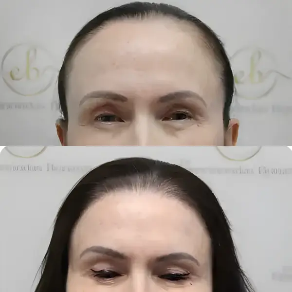 FUE hairline restoration — Dr Bonaros
