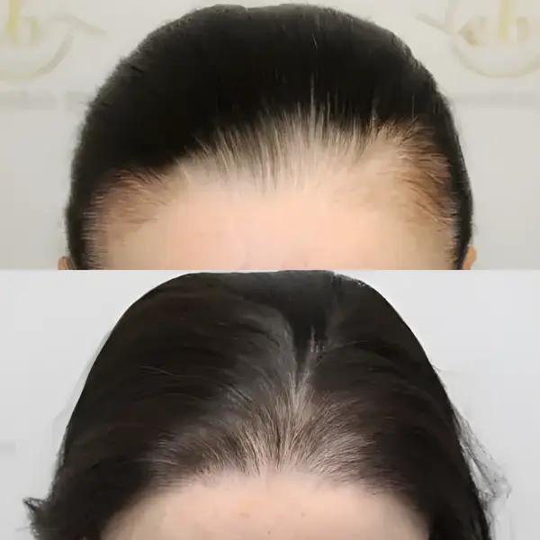 FUE hairline restoration — Dr Bonaros
