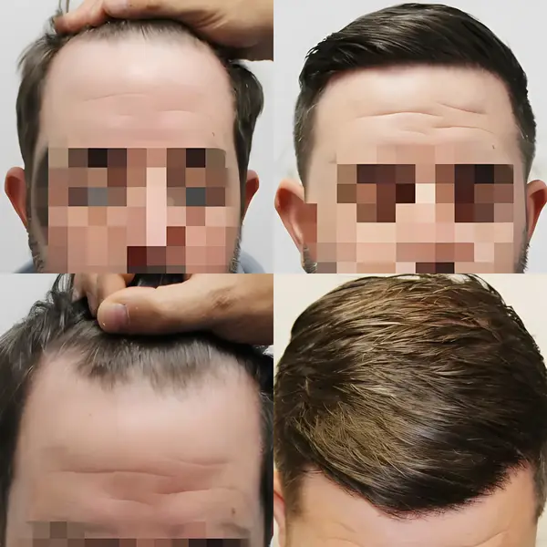 FUE hairline transplant — 1,446 grafts / 3,197 hairs