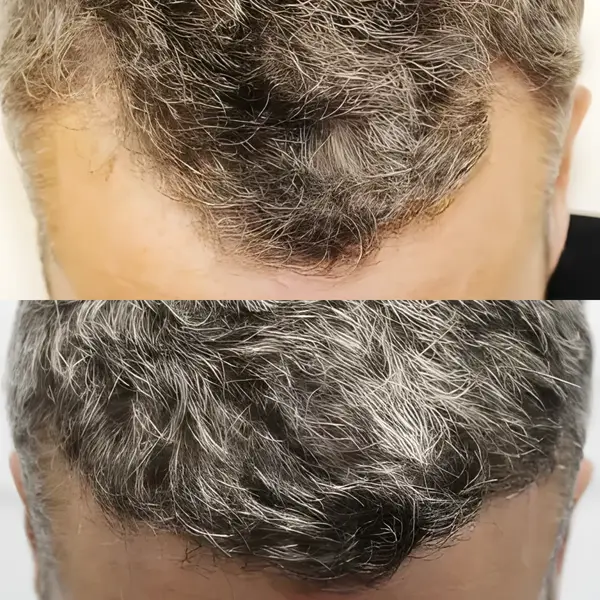 FUE receding hairline — 1,522 grafts / 3,366 hairs