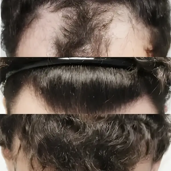 FUE hairline transplant — 2,050 grafts