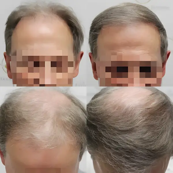 FUE frontal & mid-scalp — 1,954 grafts / 4,286 hairs