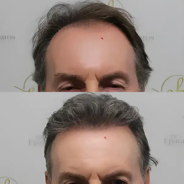 FUE hairline & crown — 3,500 grafts / 7,843 hairs