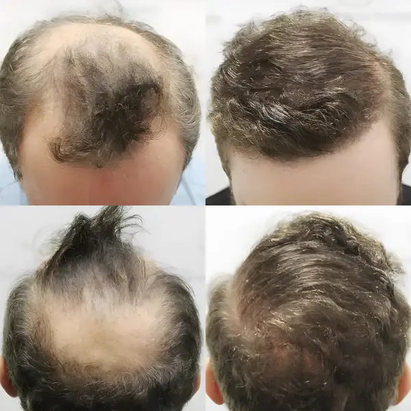 FUE hairline, crown & lateral humps — 3,986 grafts / 8,588 hairs