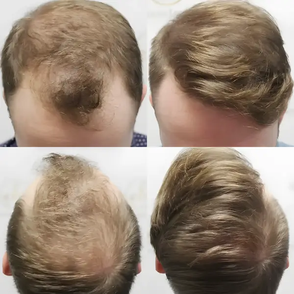 FUE hairline transplant — 1,819 grafts / 4,266 hairs