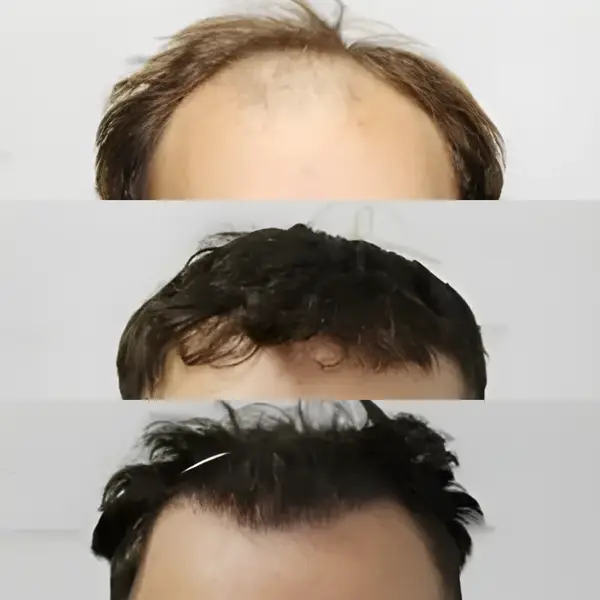 FUE receding hairline — 2,003 grafts / 4,390 hairs