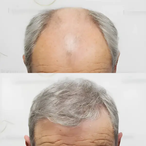 FUE advanced hair loss restoration — Dr Bonaros