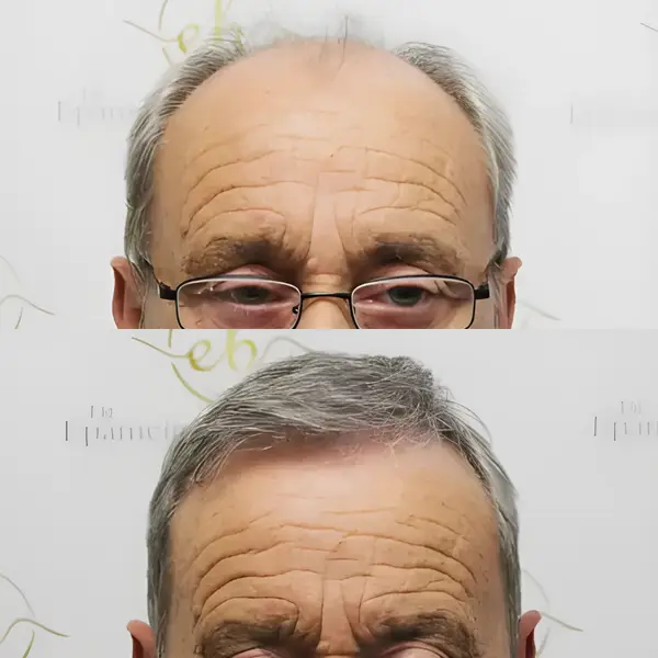 FUE hairline & mid-scalp — 3,524 grafts / 7,610 hairs