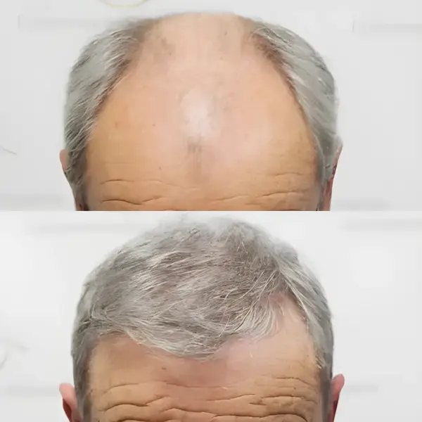 FUE hairline & mid-scalp — 3,524 grafts / 7,610 hairs