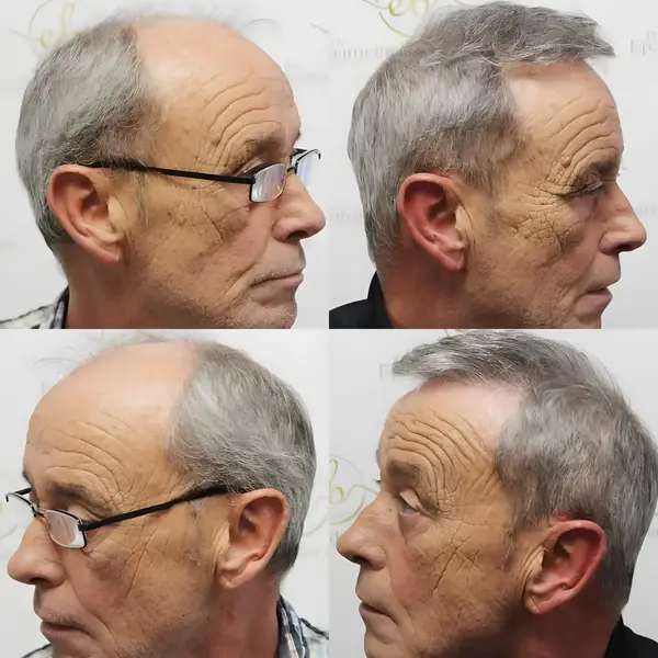FUE hairline & mid-scalp — 3,524 grafts / 7,610 hairs