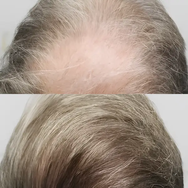 FUE hairline & crown — 3,700 grafts (two sessions)