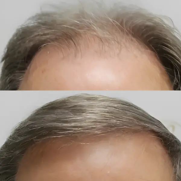 FUE hairline & crown — 3,700 grafts (two sessions)