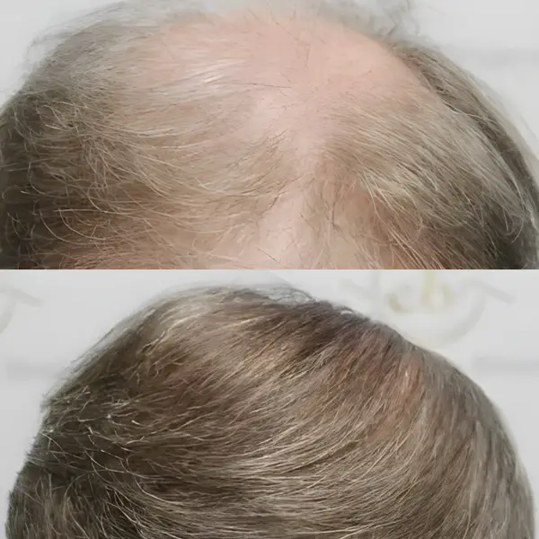 FUE hairline & crown — 3,700 grafts (two sessions)
