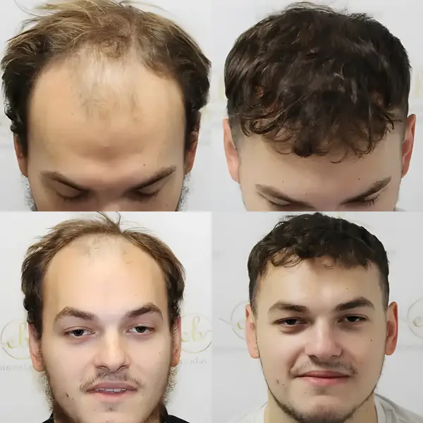 FUE receding hairline — 2,003 grafts / 4,390 hairs