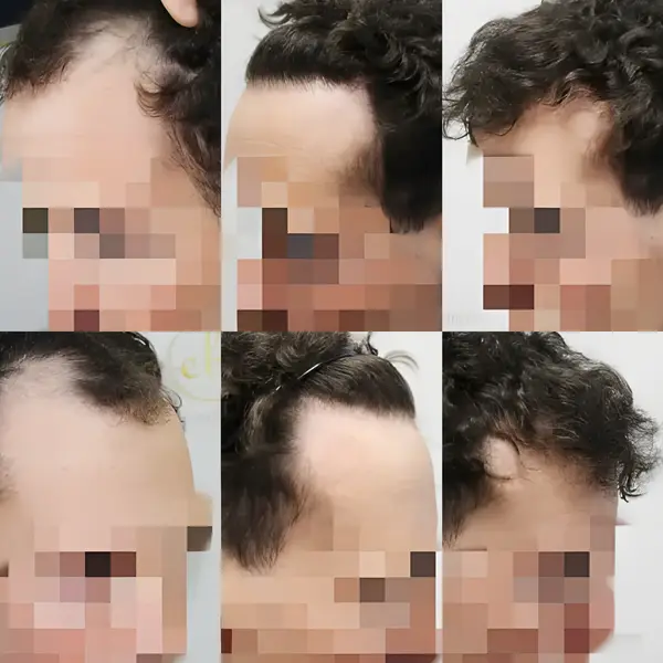 FUE hairline transplant — 2,050 grafts