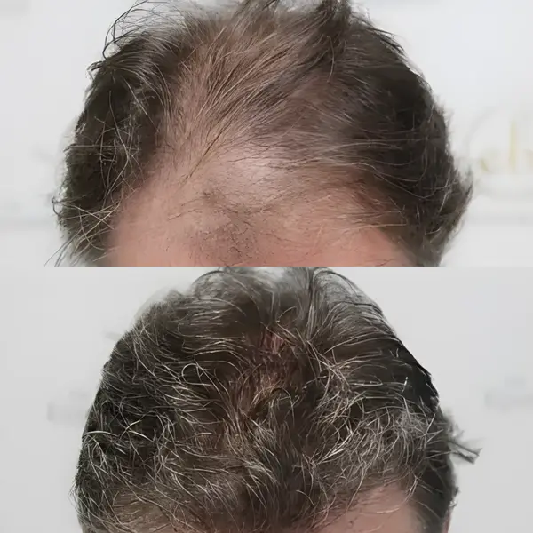 FUE hairline & crown — 3,500 grafts / 7,843 hairs