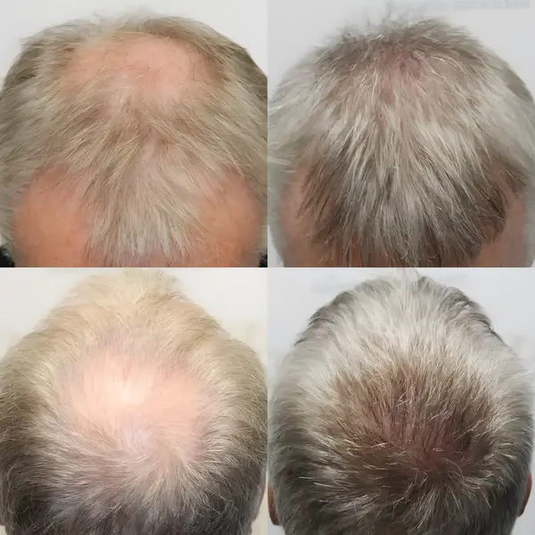 FUE hairline & crown — 3,413 grafts / 7,515 hairs