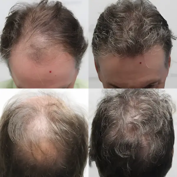 FUE hairline & crown — 3,413 grafts / 7,515 hairs