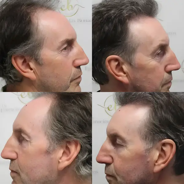 FUE hairline & crown — 3,500 grafts / 7,843 hairs