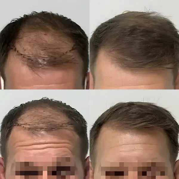 FUE hairline transplant — 2,000 grafts