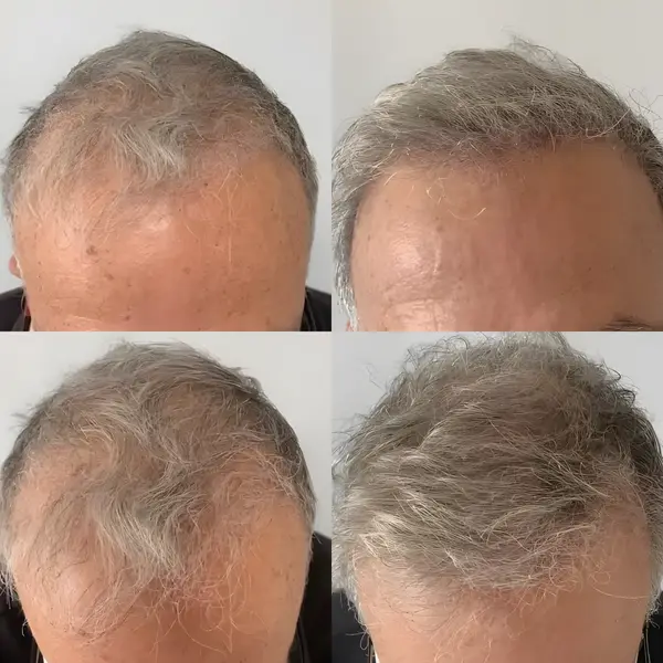 FUE frontal scalp — 1,300 grafts / 2,600 hairs