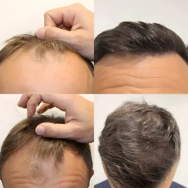 FUE receding hairline — 2,042 grafts / 4,933 hairs