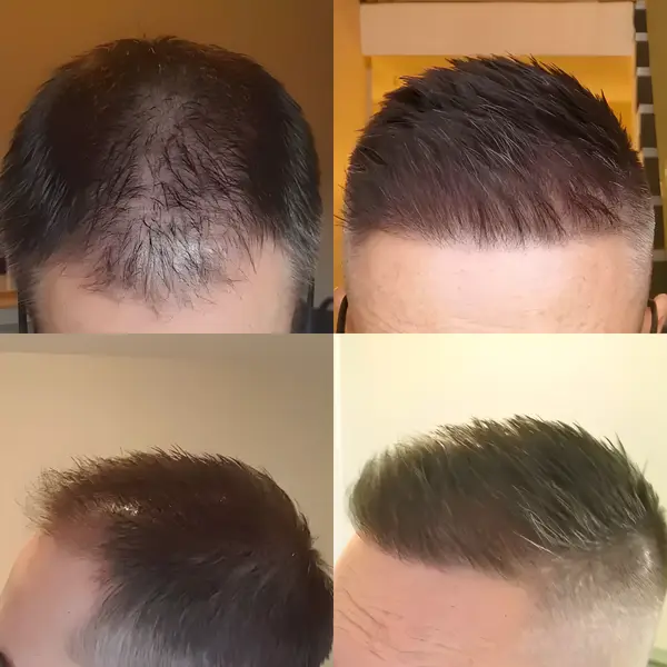 FUE hairline transplant — 1,208 grafts / 2,929 hairs