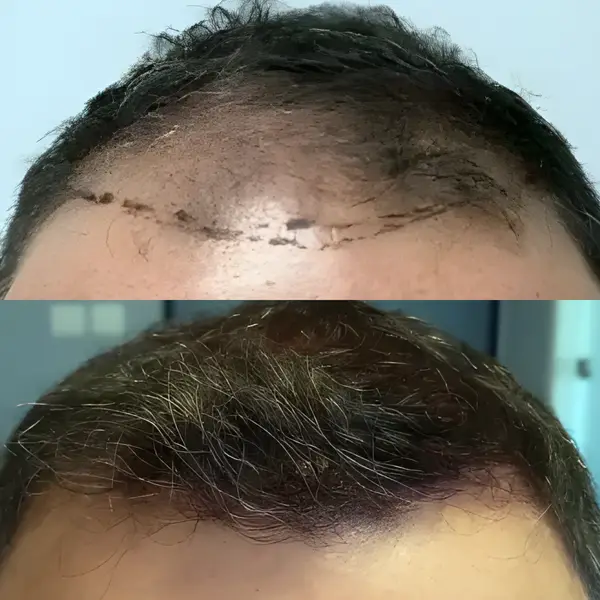 FUE frontal scalp — 1,720 grafts / 5,120 hairs
