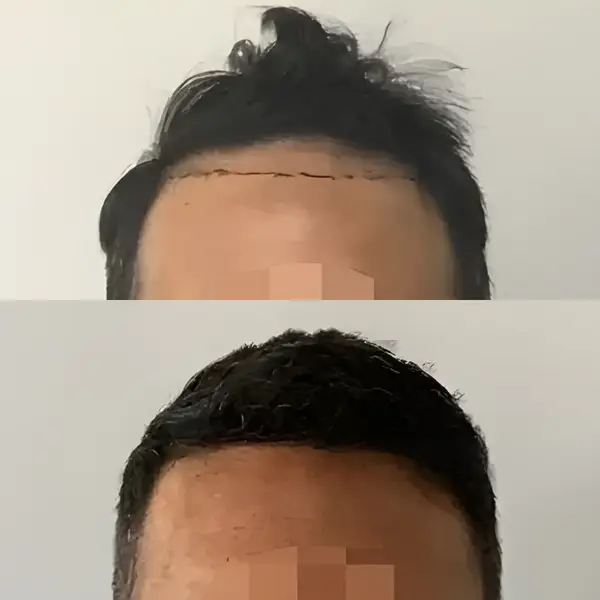 FUE hairline & frontal third — 1,649 grafts / 3,916 hairs