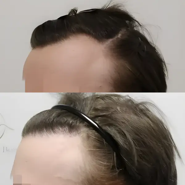 FUE receding hairline — 1,614 grafts / 3,577 hairs