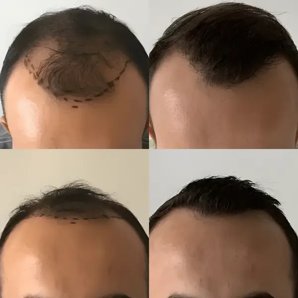 FUE mature hairline — 1,800 grafts