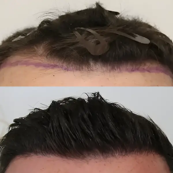FUE receding hairline — 1,456 grafts / 3,621 hairs