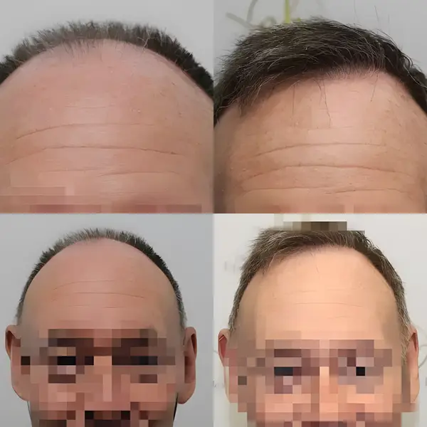 FUE hairline transplant — 1,662 grafts / 3,144 hairs