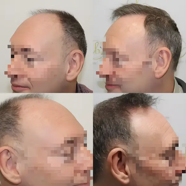FUE hairline transplant — 1,662 grafts / 3,144 hairs