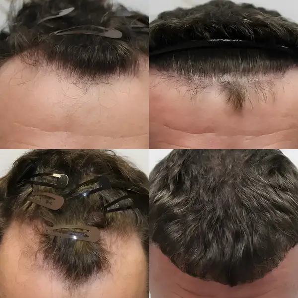 FUE hairline transplant — 2,026 grafts / 5,169 hairs