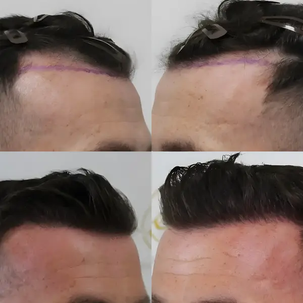 FUE receding hairline — 1,456 grafts / 3,621 hairs