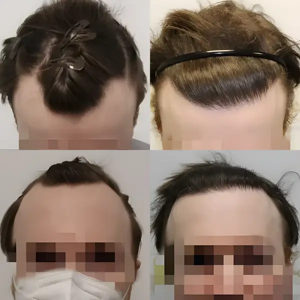 FUE receding hairline — 1,614 grafts / 3,577 hairs