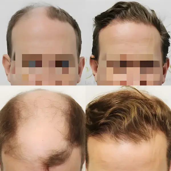 FUE frontal & mid-scalp — 4,012 grafts