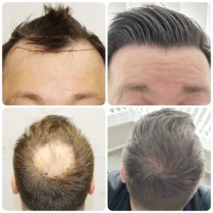 Hair restoration result