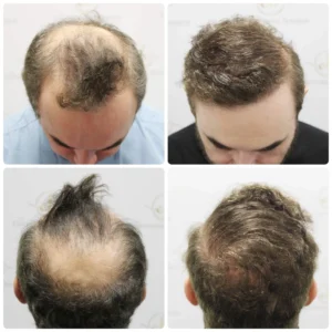 Hair restoration result