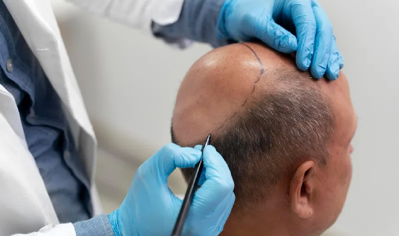 FUE vs FUT: which technique is right for you?